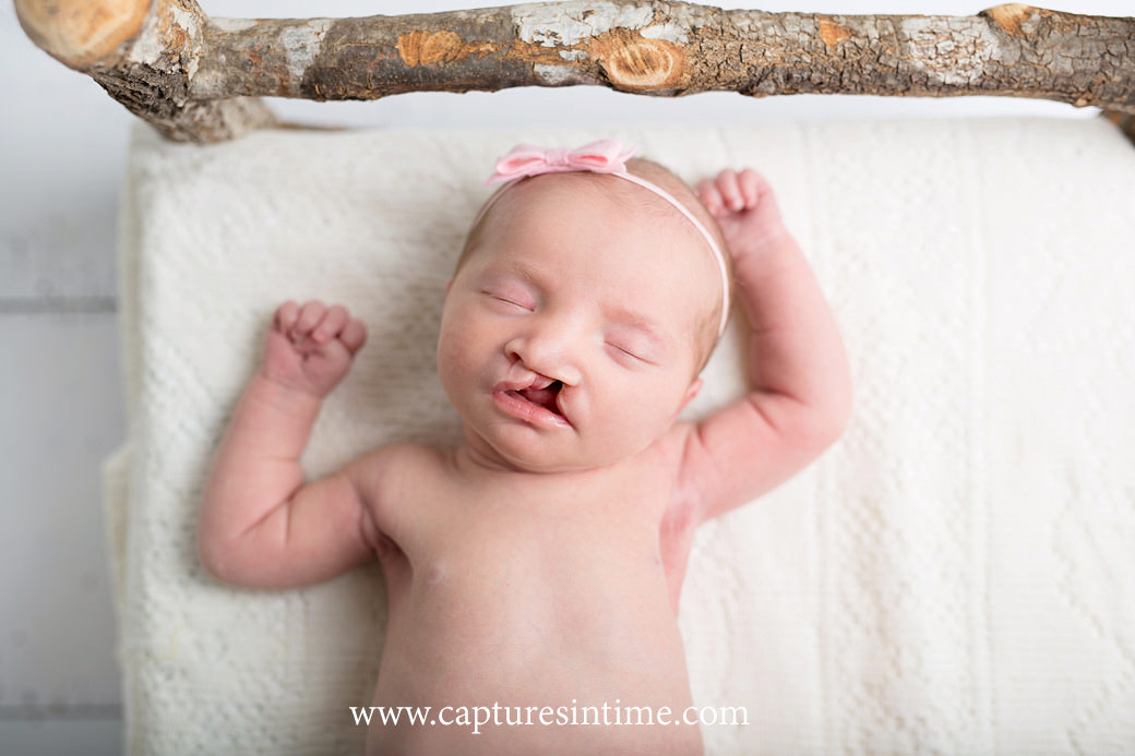 kansas city newborn baby photography newborn baby girl with cleft lip sleeping on birch bead